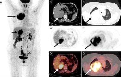 Case report: High-grade endometrial stromal sarcoma with adrenal glands metastases: An unreported site of metastasis